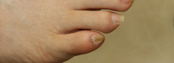 母趾の爪が生えてこない 一般社団法人 足の番人 公式 足の知識 活動報告