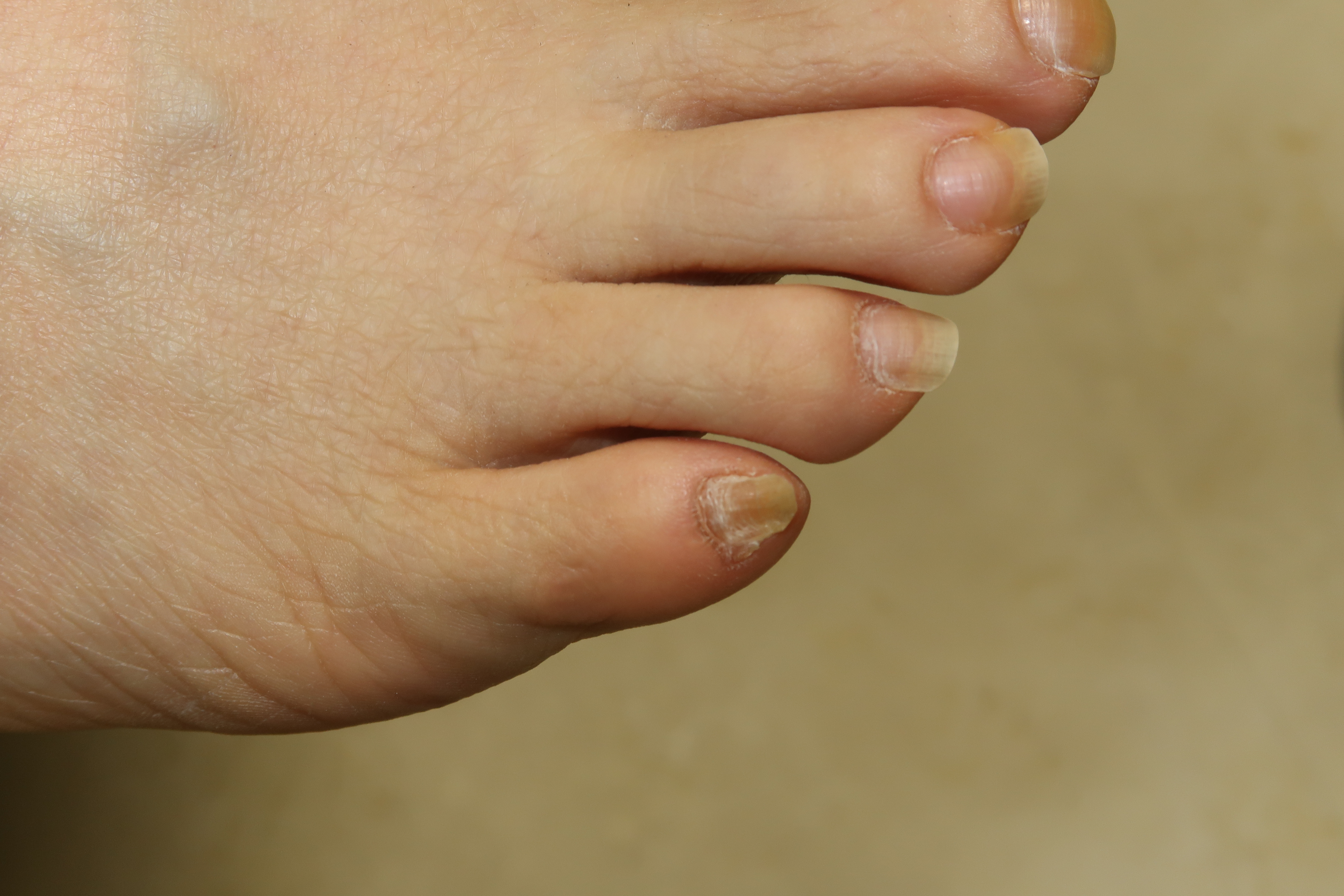 あなたの足の小指の爪 変形していませんか 一般社団法人足の番人 足の知識 活動報告