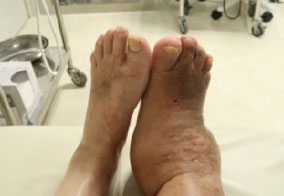 危険な足1糖尿病足病変